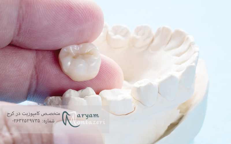 انواع-مواد-برای-پر-کردن-و-ترمیم-دندان