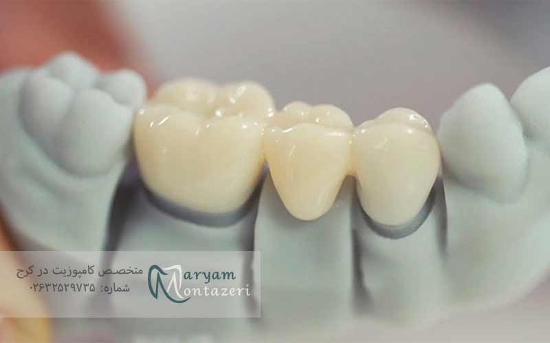 ترمیم-دندان-چگونه-انجام-می‌شود؟