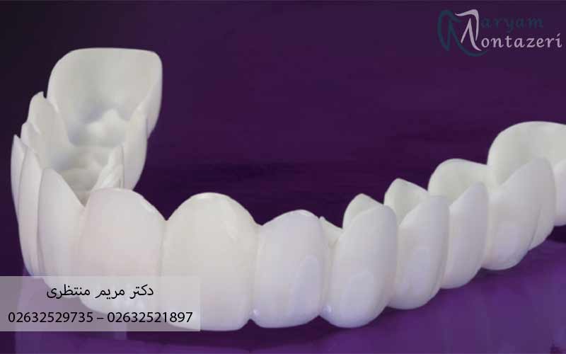 لمینت-دندان-در-کرج-دکتر-مریم-منتظری