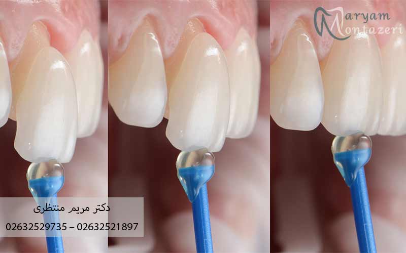 لمینت-دندان-چه-کاربردی-دارد
