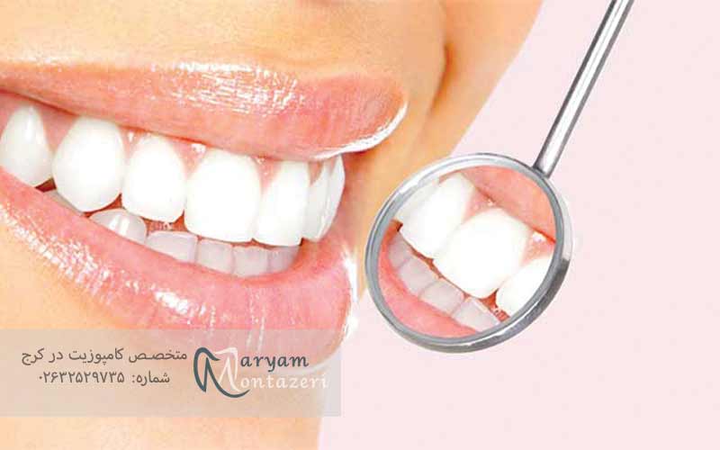 کامپوزیت-های-دندانی-و-مزایای-و-معایب-آن