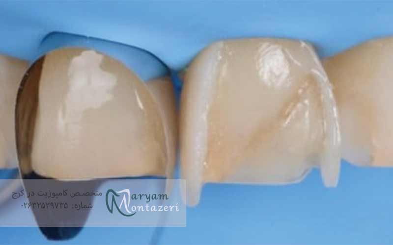 یک-واحد-کامپوزیت-دندان-چیست