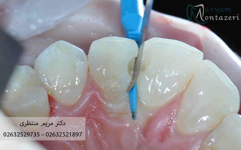 بهترین-زمان-برای-پولیش-کامپوزیت-دندان