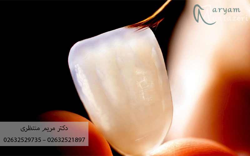 تراشیدن-دندان-قبل-از-لمینت