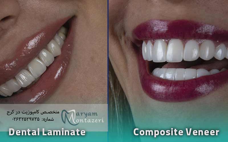 تفاوت-کامپوزیت-و-لمینیت-سرامیکی