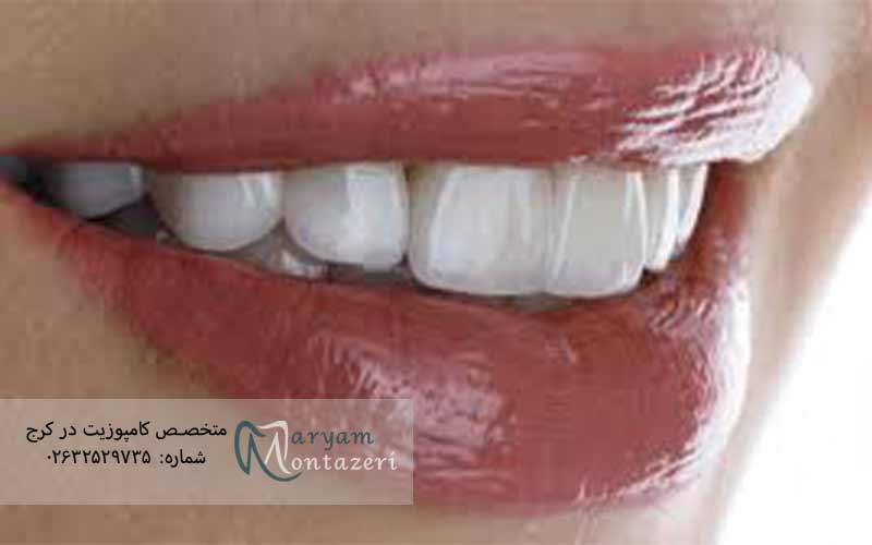 دلایل-افتادن-ونیر-دندان
