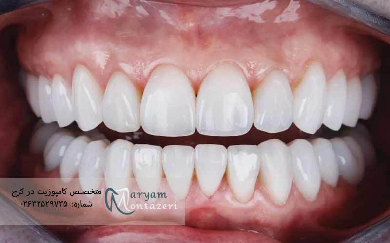 راهکارهای-پیشگیری-از-افتادن-ونیر