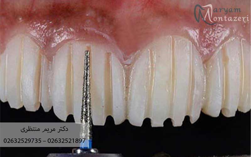 عکس-تراشیدن-دندان-برای-لمینیت