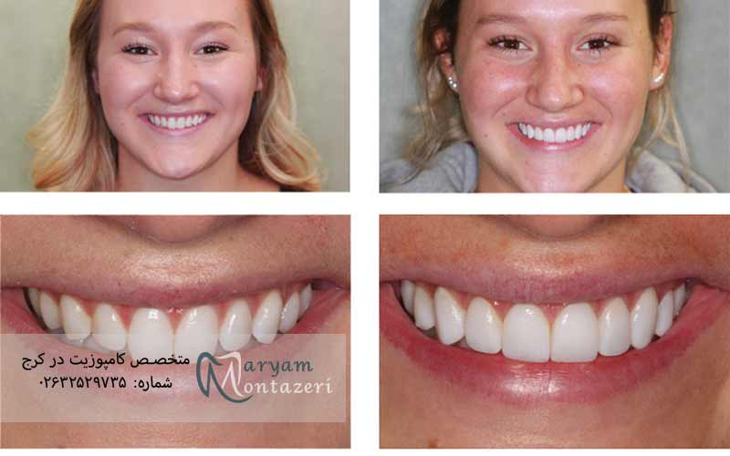 فرق-کامپوزیت-ونیر-با-لمینت-سرامیکی-به-زبان-ساده