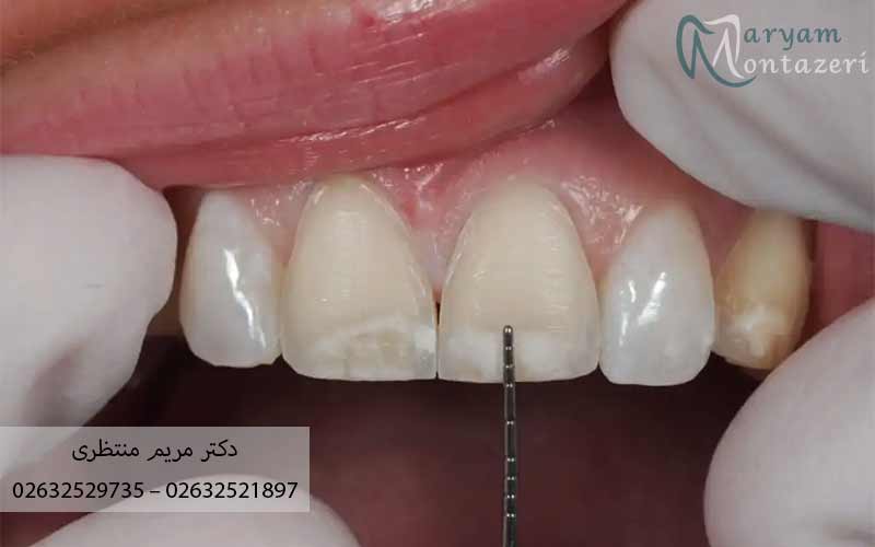 مراحل-تراشیدن-دندان-قبل-از-لمینت