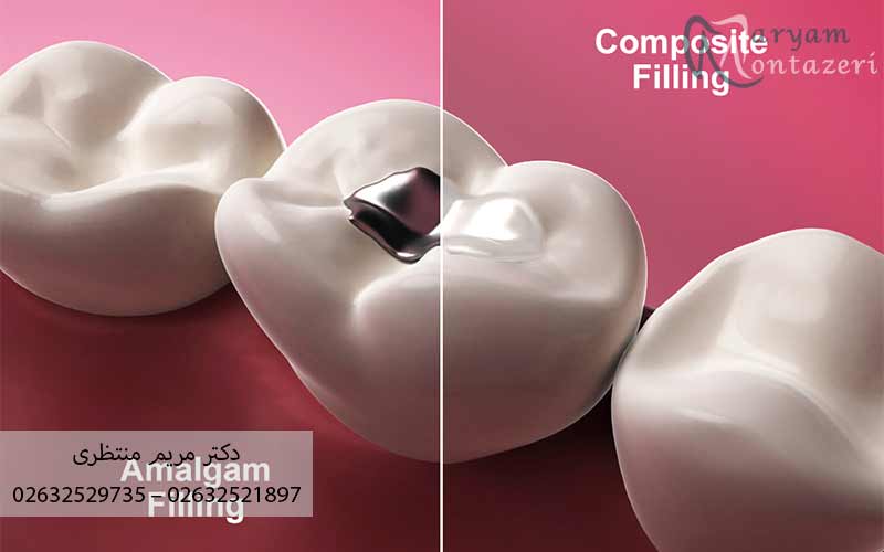 مقایسه-آمالگام-و-کامپوزیت