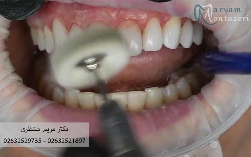 هزینه-پولیش-دندان-۱۴۰۴