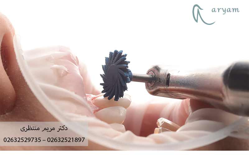 پولیش-کامپوزیت