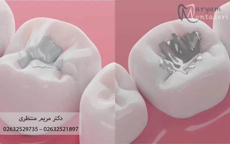 چه-زمانی-آمالگام-بهتر-است؟