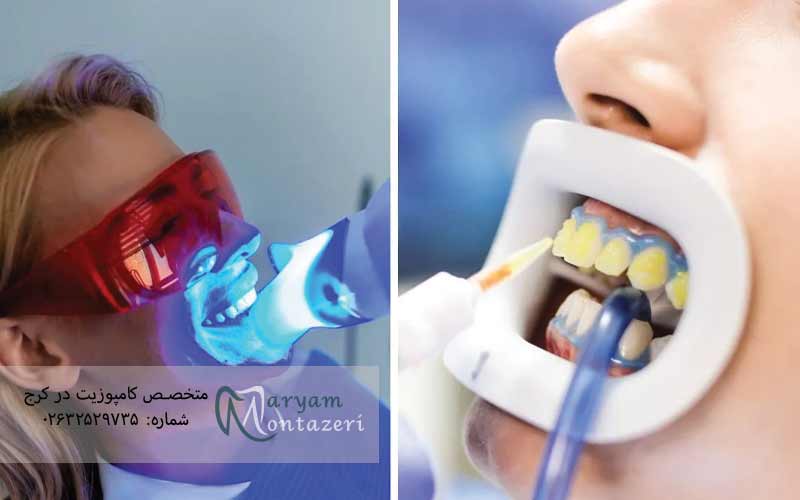 آیا-بلیچینگ-دندان-دائمی-است