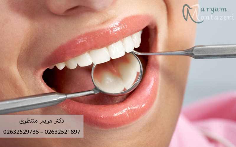 آیا-ونیر-کامپوزیت-ضرر-دارد