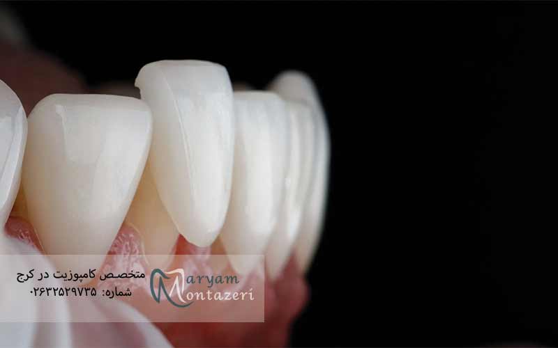تفاوت-ونیر-با-لمینت-و-کامپوزیت-دندان-جلو