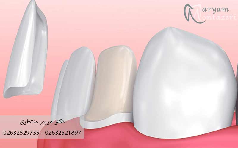 تفاوت-کامپوزیت-با-کامپوزیت-ونیر