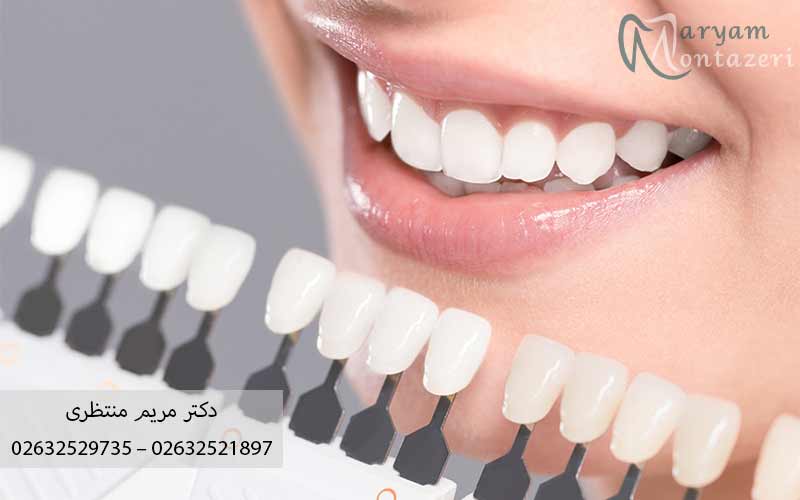 جدول-مقایسه‌-کامپوزیت-با-کامپوزیت-ونیر