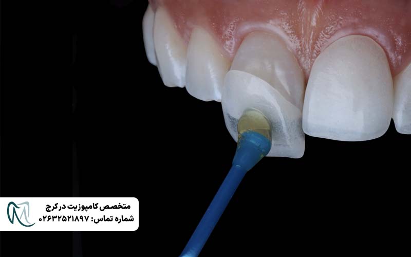 دوام کامپوزیت ونیر