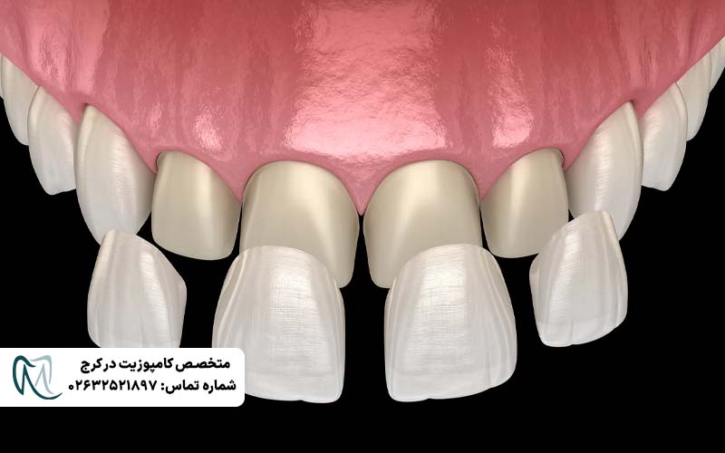 دوام کامپوزیت ونیر