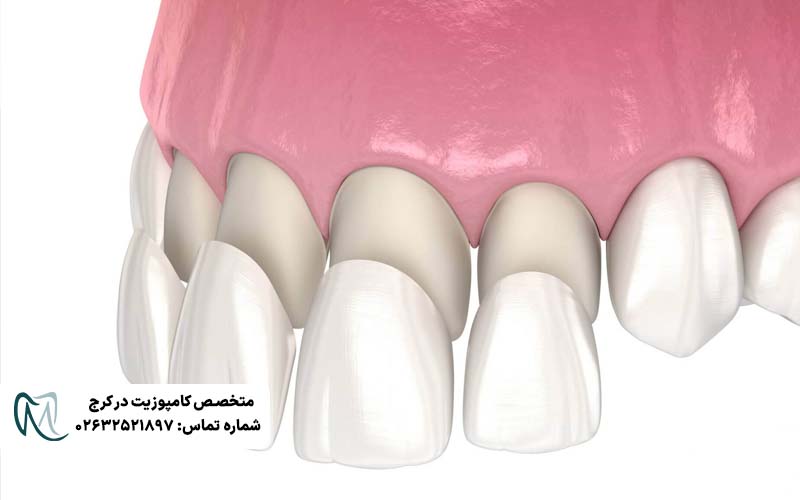 دوام کامپوزیت ونیر