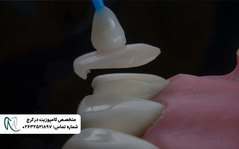 دوام کامپوزیت ونیر