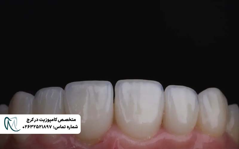 دوام کامپوزیت ونیر