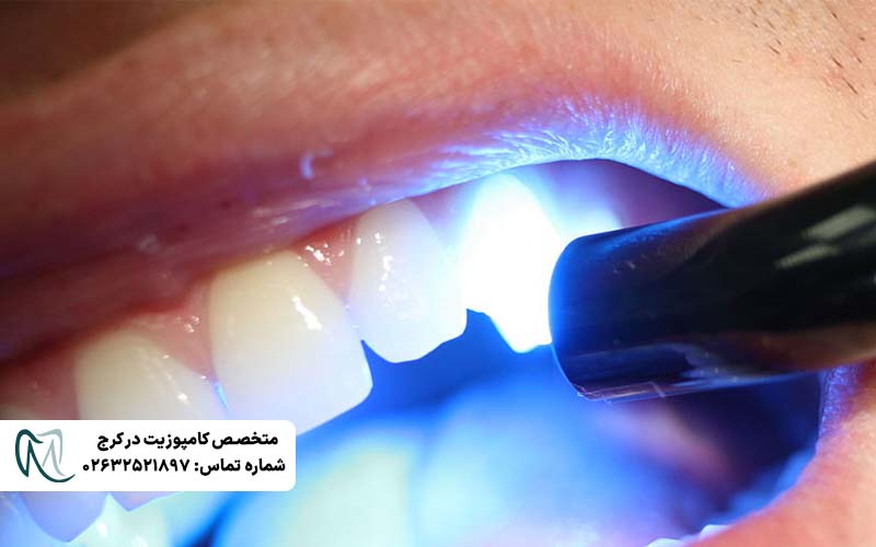 کامپوزیت بدون تراش