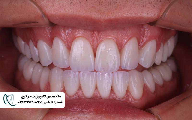 دوام کامپوزیت ونیر
