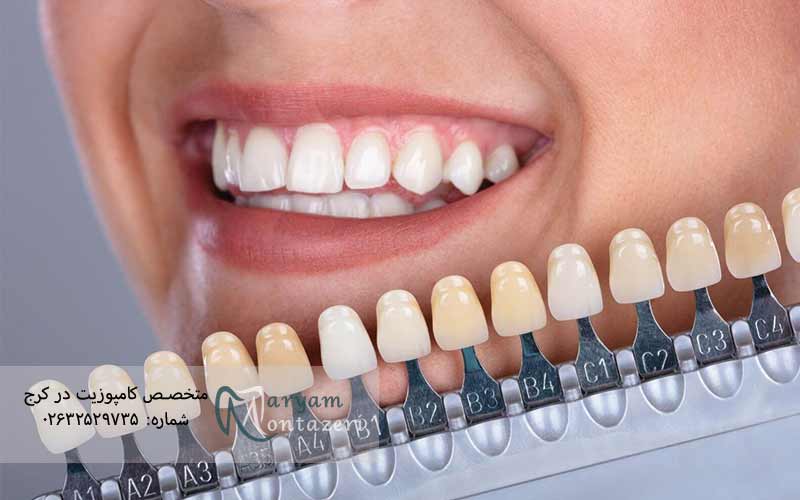 رنگ-دندان-A3-در-کامپوزیت-و-لمینت