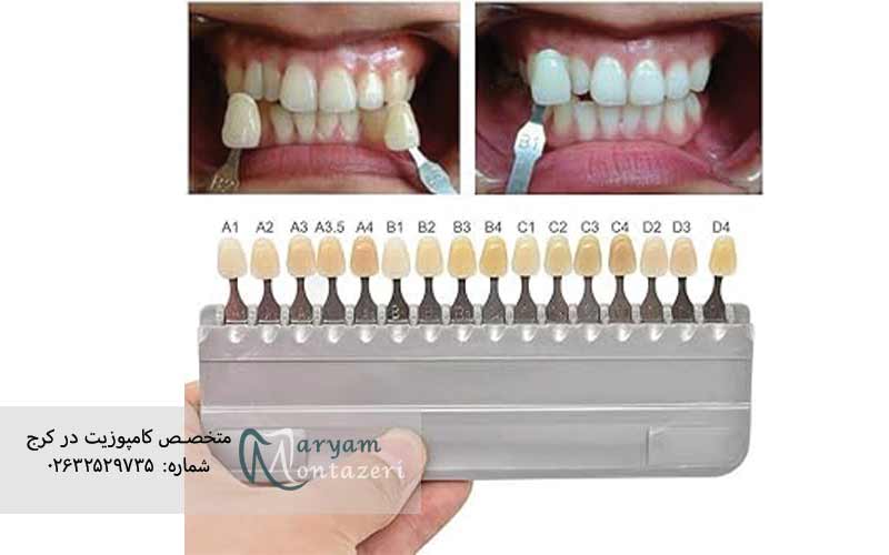 سیستم-رنگ‌بندی-دندان