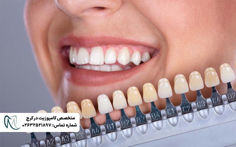 انتخاب رنگی طبیعی لمینت دندان