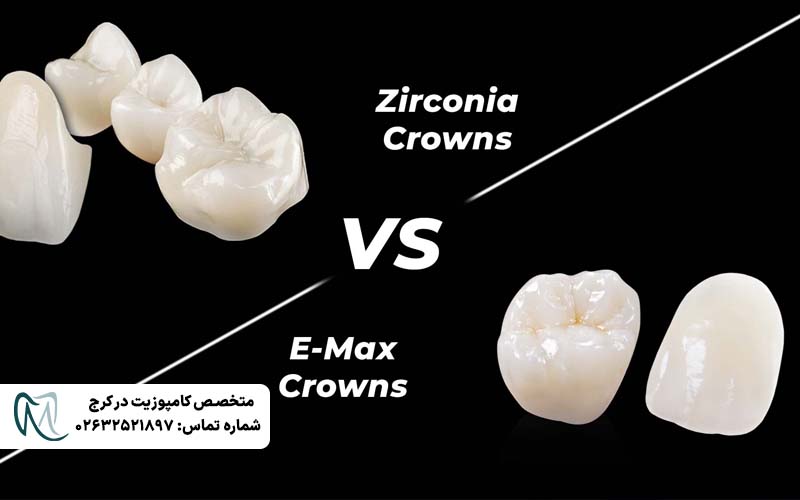 تفاوت لمینت Emax و زیرکونیا