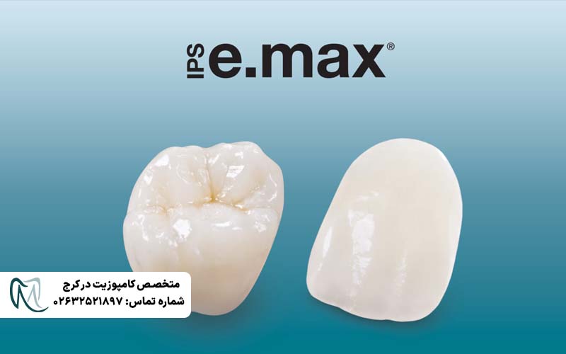 تفاوت لمینت Emax و زیرکونیا