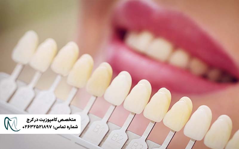 انتخاب رنگی طبیعی لمینت دندان