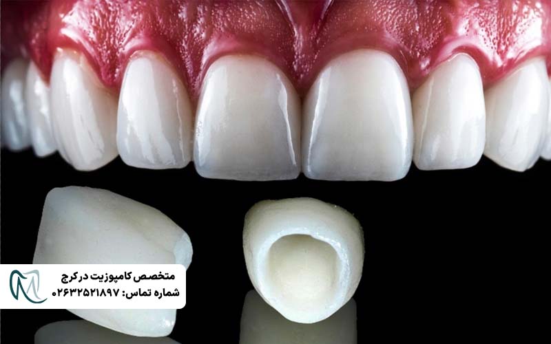 تفاوت لمینت Emax و زیرکونیا