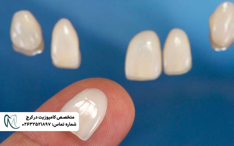 تفاوت لمینت Emax و زیرکونیا