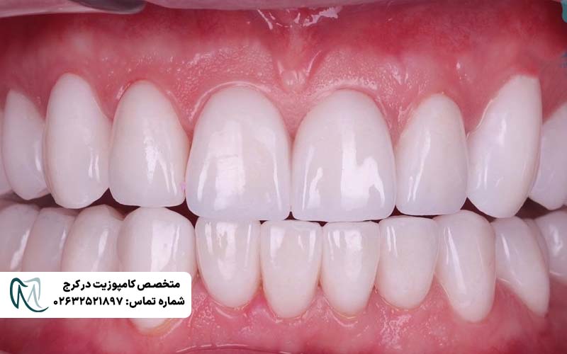 تفاوت لمینت Emax و زیرکونیا