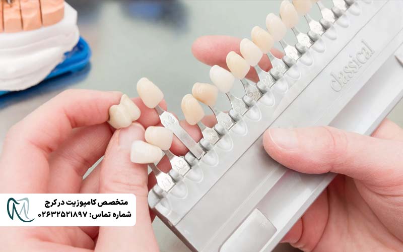 انتخاب رنگی طبیعی لمینت دندان