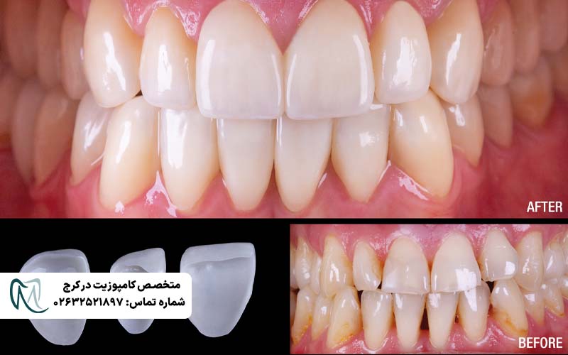 تفاوت لمینت Emax و زیرکونیا