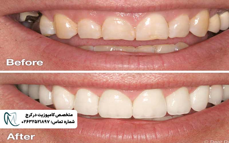 انواع طرح لبخند دندان