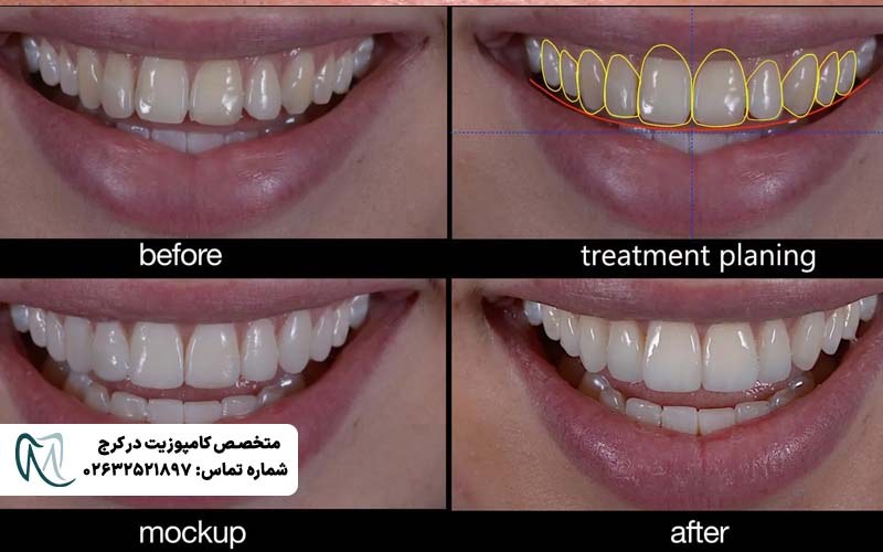انواع طرح لبخند دندان