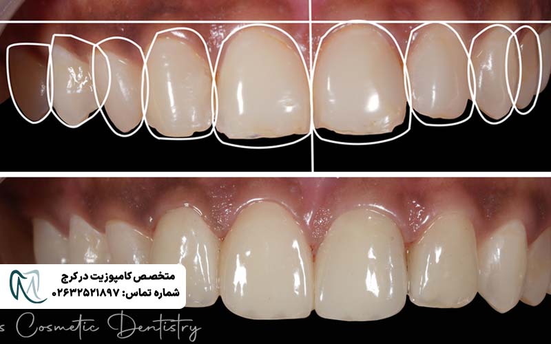 انواع طرح لبخند دندان
