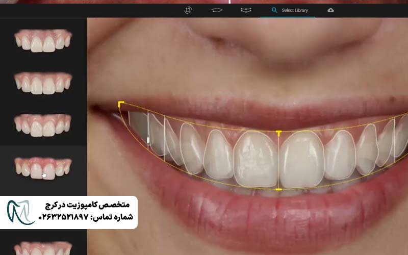 انواع طرح لبخند دندان