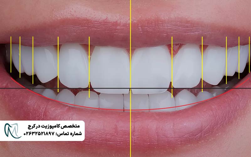 انواع طرح لبخند دندان