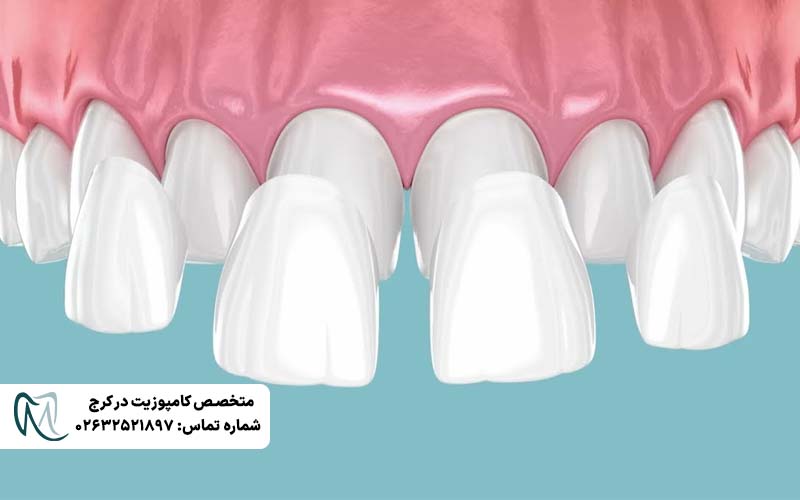 لمینت لومینیرز دندان