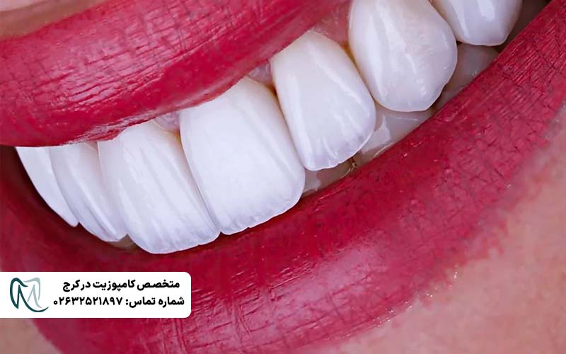 لمینت لومینیرز دندان