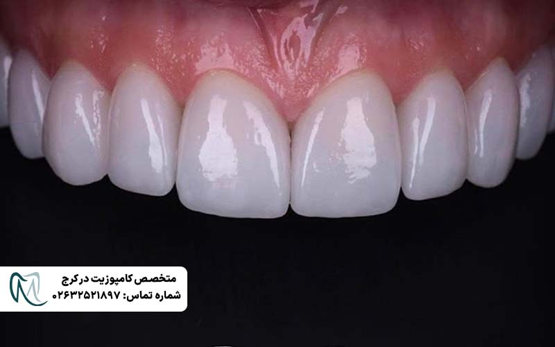 لمینت لومینیرز دندان