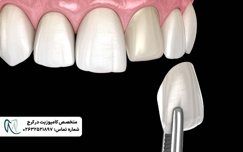 لمینت لومینیرز دندان